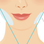 masseter botox vorher nachher