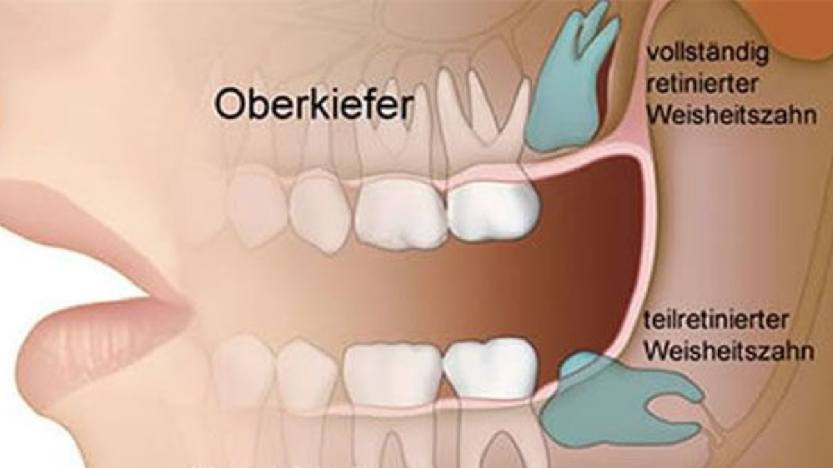 5 tage nach weisheitszahn-op noch schmerzen
